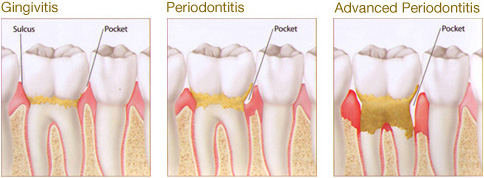 Periodontal Gum Disease Las Vegas
