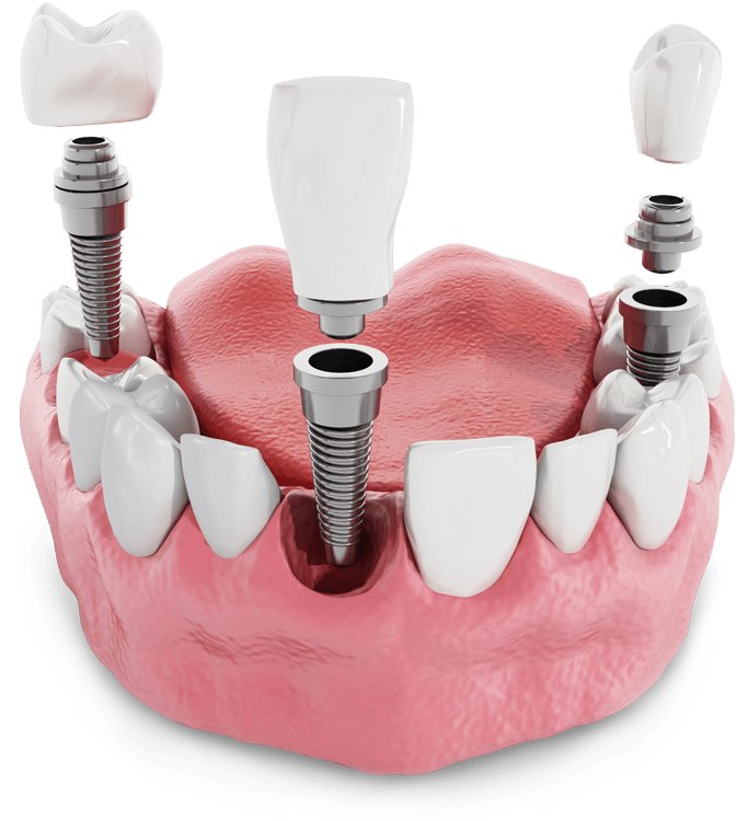 Dental Implants Model