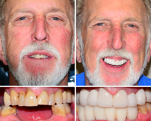 Before and After Dental Implants in Las Vegas
