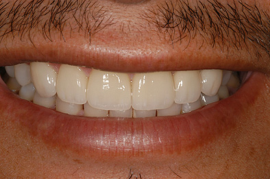 After Cosmetic Dental Procedure 1