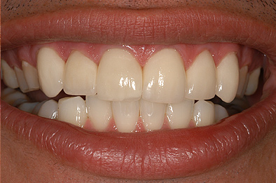 After Dental Veneers 15
