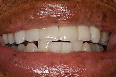 After Dental Restoration 5
