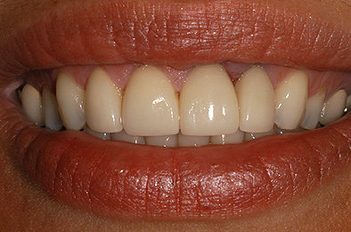 After Dental Veneers 6