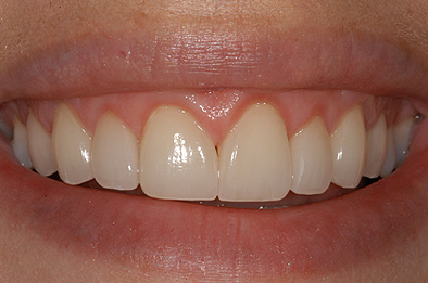 After Dental Veneers 3