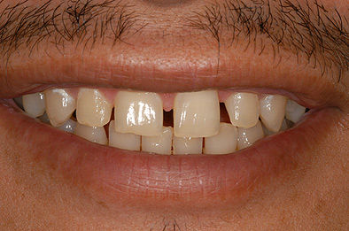 Before Cosmetic Dental Procedure 1