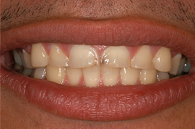 Before Dental Veneers 5