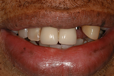 Before Dental Restoration 5