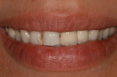Before Dental Veneers 6