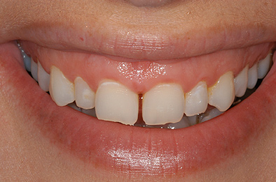 Before Dental Veneers 3