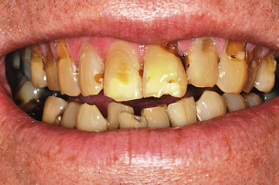 Before Dental Implants 1