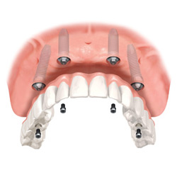 Screw Retained Upper Implant Denture in Las Vegas