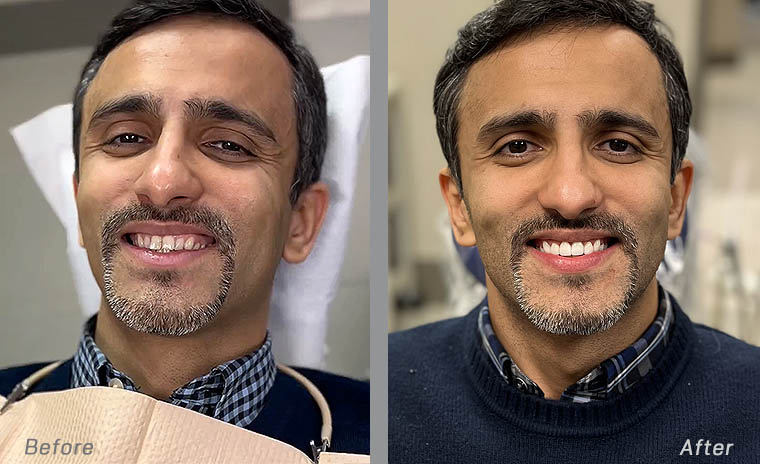 Las Vegas Veneers Before and After